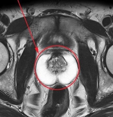 Prostate saine pour l'échographie après avoir pris Uroosaf