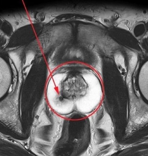 Prostatite pour l'échographie avant de prendre Urosaf