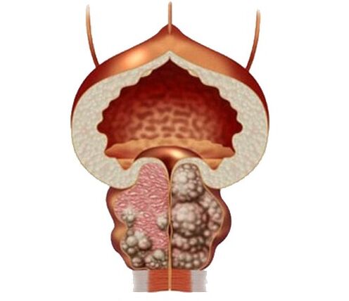 adénome et œdème de la prostate et du traitement avec des capsules d'Urosaf