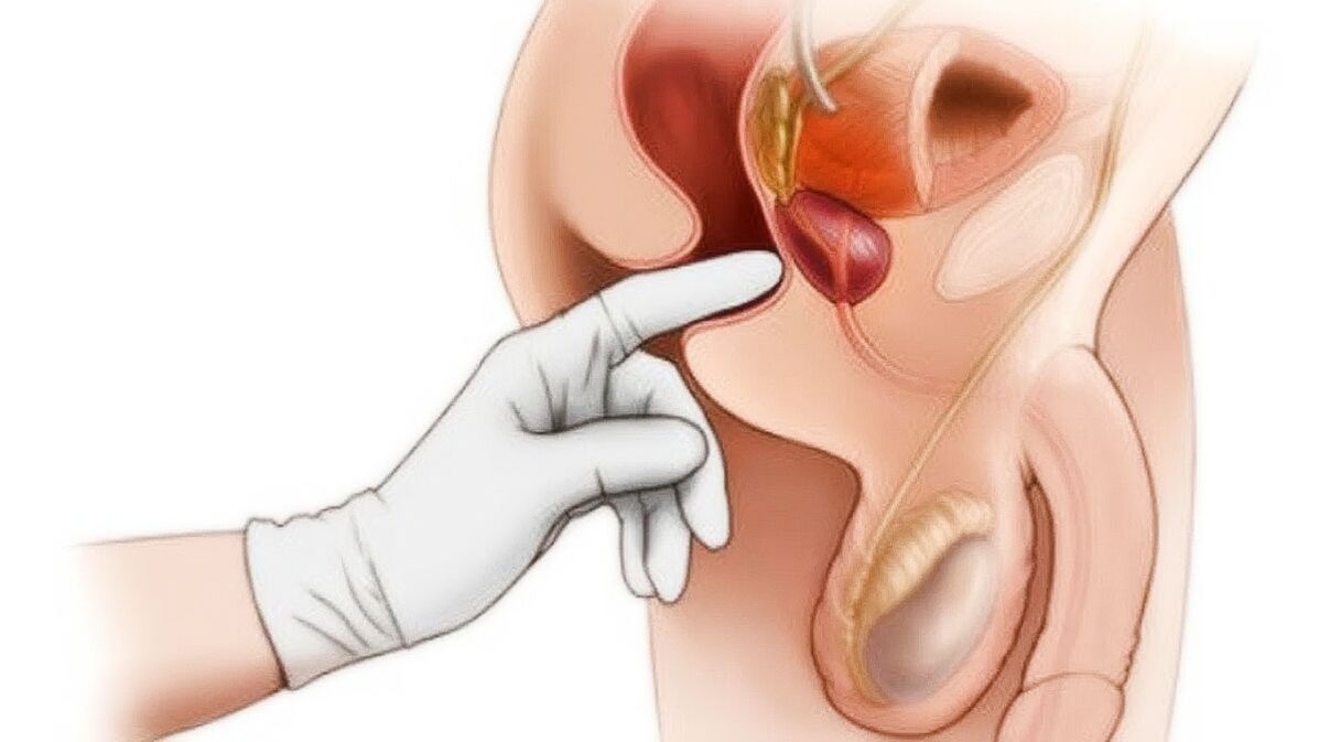 Massage de la prostate