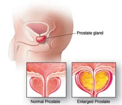Prostate normal et enflammé