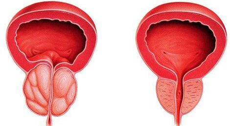 La différence de prostate malade et saine